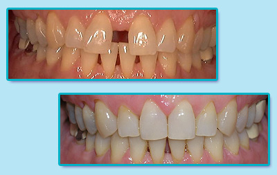 Before and After Invisalign Treatment