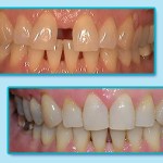 Before and After Invisalign Treatment