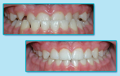 Before and After Invisalign Treatment