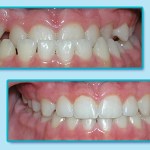 Before and After Invisalign Treatment