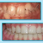 Before and After Invisalign Treatment