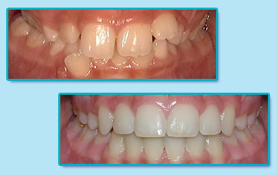 Before and After Invisalign Treatment