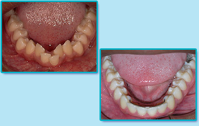 Before and After Invisalign Treatment