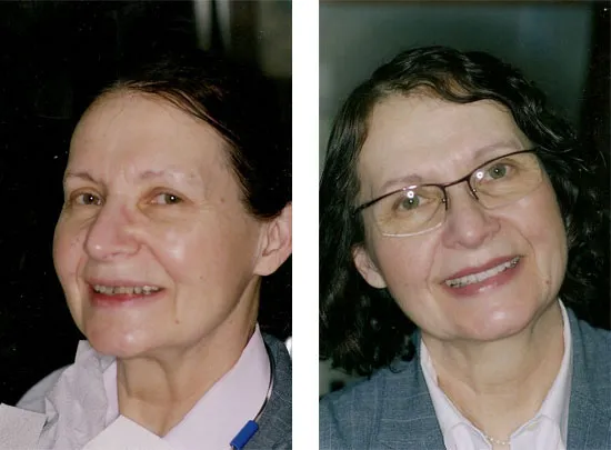 Before and After Dental Treatment