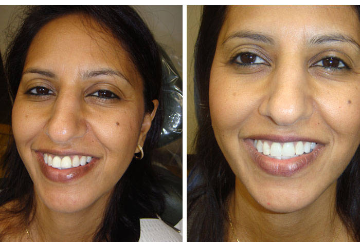 Before and After Dental Treatment