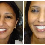Before and After Dental Treatment