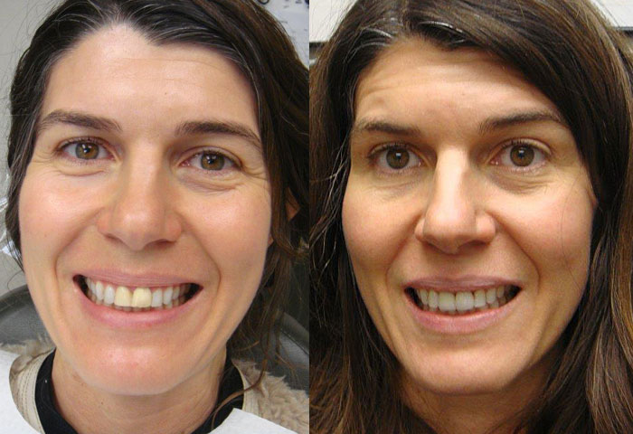 Before and After Dental Treatment